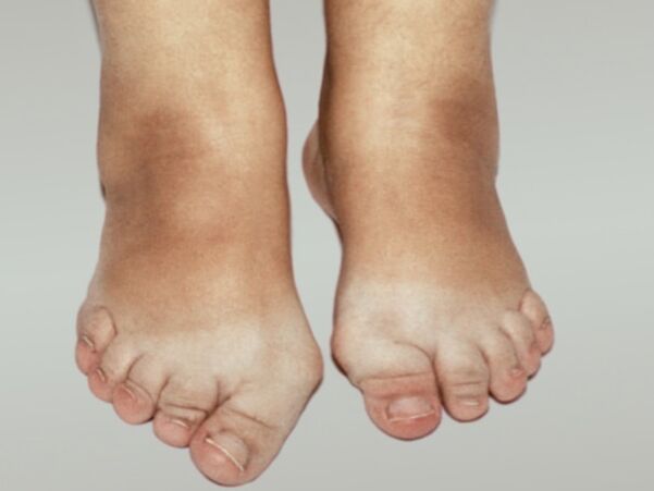 Choroba zwyrodnieniowa stopy z ciężką deformacją palców