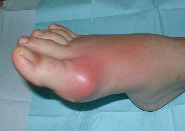 Obraz kliniczny zapalenia stawów stóp - obrzęk i stan zapalny