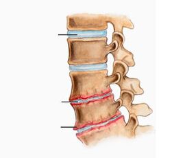 Osteochondroza