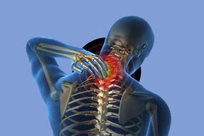 Objawy osteochondrozy szyjnej