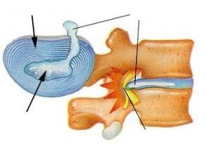 zniszczenie pierścienia włóknistego w osteochondrozie szyjnej