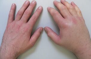 bóle stawów jako przyczyna bólu stawów palców