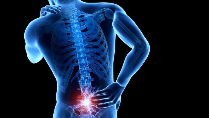 ból pleców z osteochondrozą lędźwiową